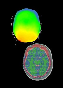 电磁模拟用于评估脑电图与核磁共振成像相结合的安全性